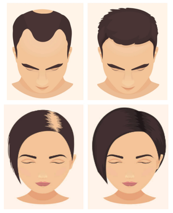 Finasterida 1 mg - Tratamento Para Queda De Cabelo Calvíce 60 Caps - Image 3